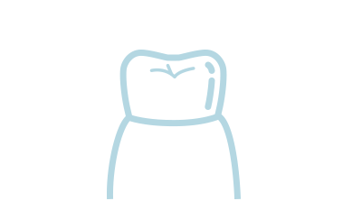 [イラスト]セラミック修復