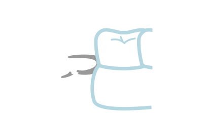 [イラスト]入れ歯の修理