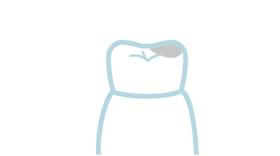 [イラスト]むし歯の治療