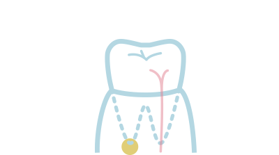 [イラスト]歯の根・神経の治療