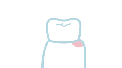 [イラスト]歯周病の治療